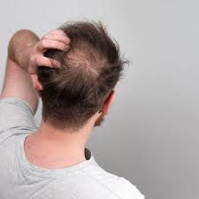 hair loss